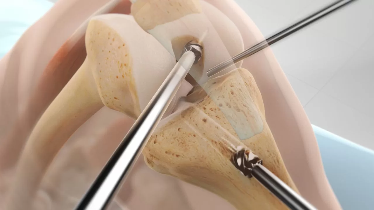 مراحل انجام جراحی بازسازی PCL