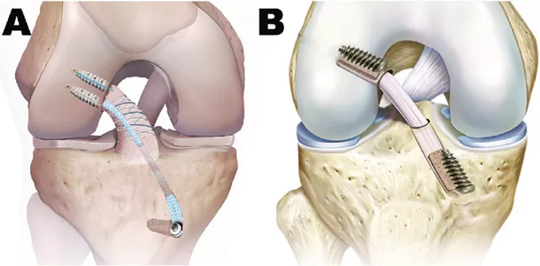 جراحی ACL Avulsion