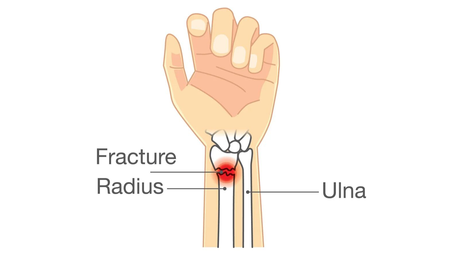 شکستگی ساعد دست و روشهای درمان آن