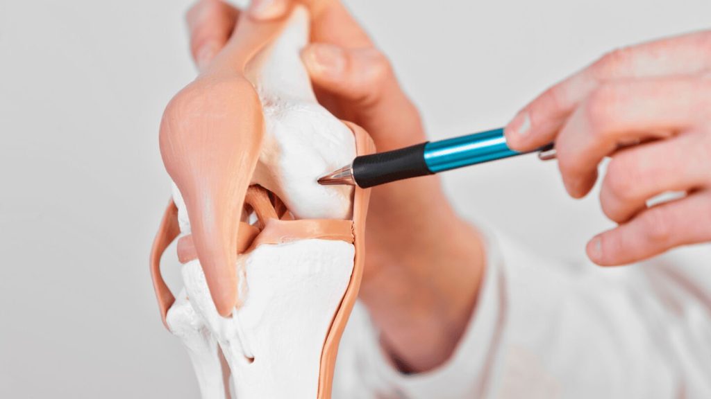 درمان کندرومالاسی یا نرمی کشکک زانو چیست؟