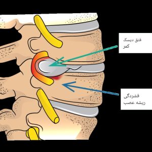 دیسک کمر چیست؟ بررسی علائم، علت‌ها و جدیدترین روش‌های درمان