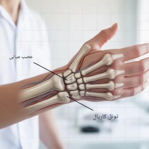 سندرم تونل کارپال؛ علائم، روش‌های تشخیص و جدیدترین تکنیک‌های جراحی