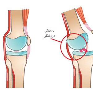 دلایل خالی کردن زانو و راه و روش درمان آن