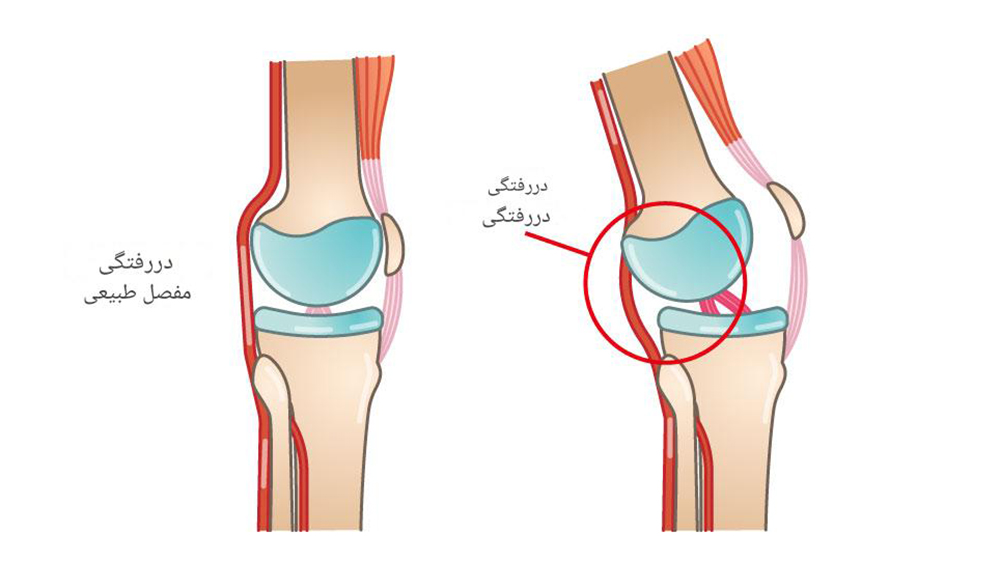 دلایل خالی کردن زانو و راه و روش درمان آن