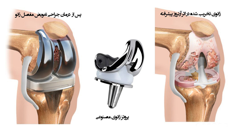 درمان ساییدگی زانو؛ کاهش درد، کنترل آرتروز