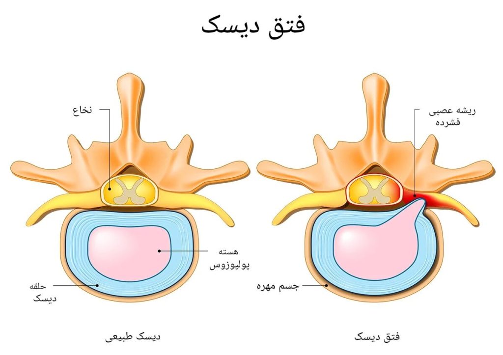 دیسک کمر چیست؟ بررسی علائم، علتها و جدیدترین روشهای درمان