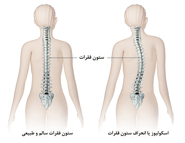 علائم بیماری های ستون فقرات چیست؟ 5 نشانه از علائم بیماری های ستون فقرات
