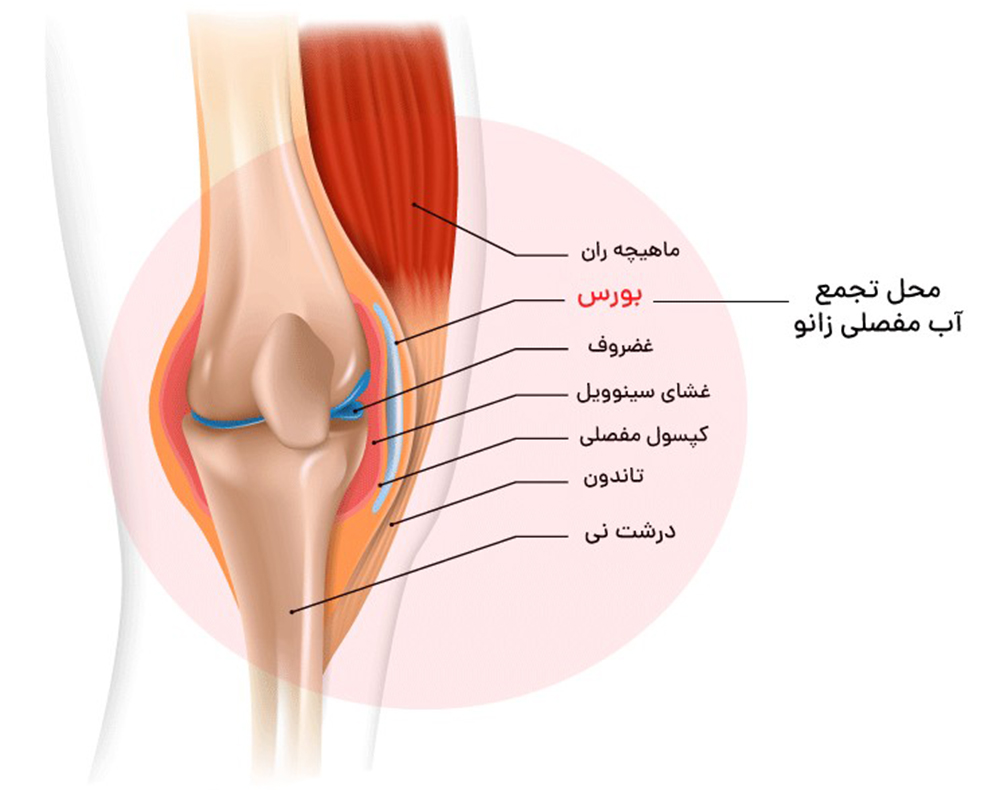 علت اصلی آب آوردن زانو + درمان فوری