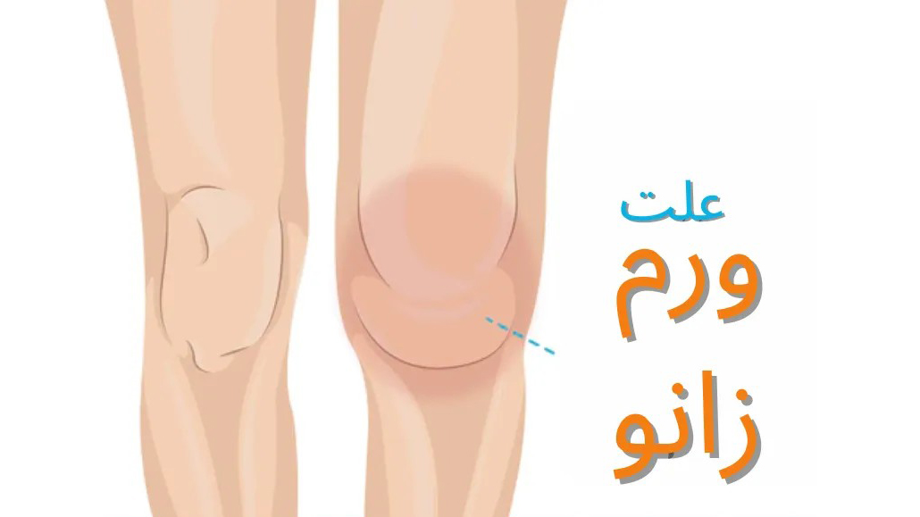 تورم زانو