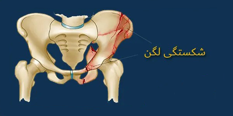 شکستگی لگن چه علائم و راه درمانی دارد؟