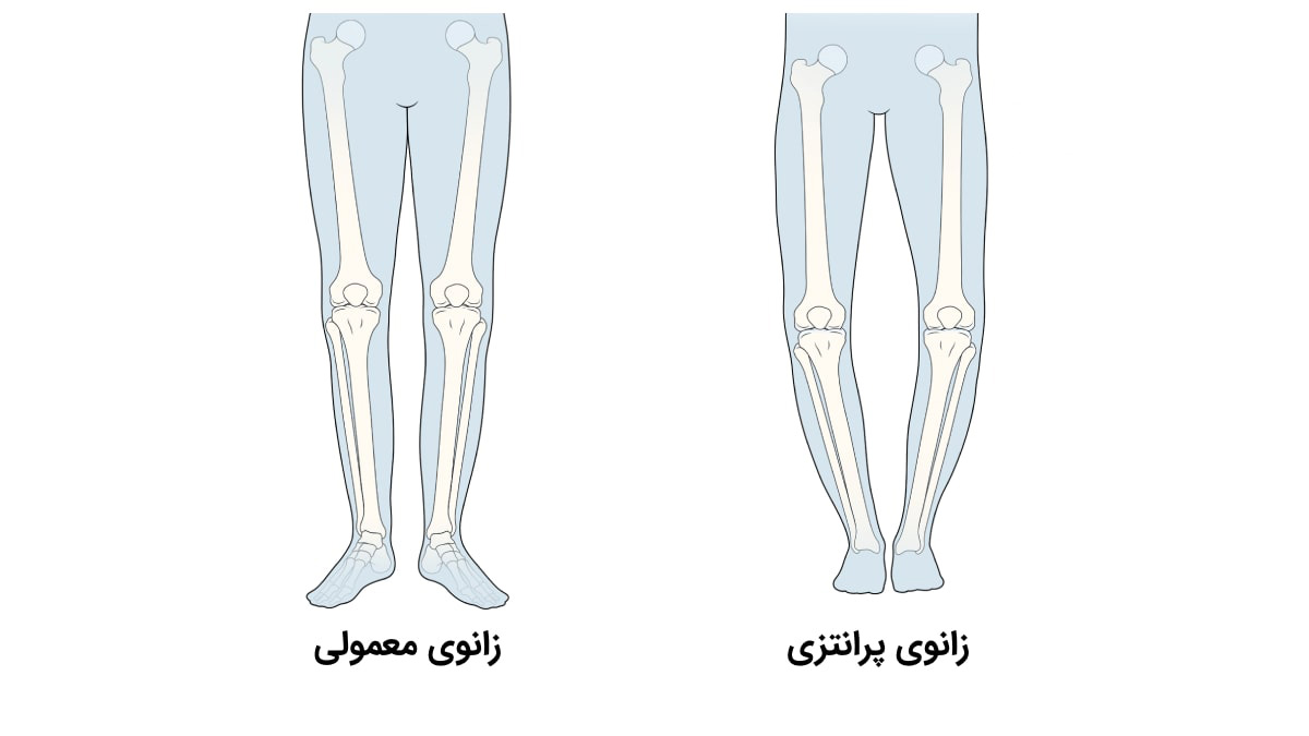 زانوی پرانتزی چیست و چگونه درمان می شود؟