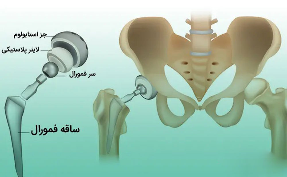 فیزیوتراپی و مراقبت های بعد از تعویض مفصل لگن و ران