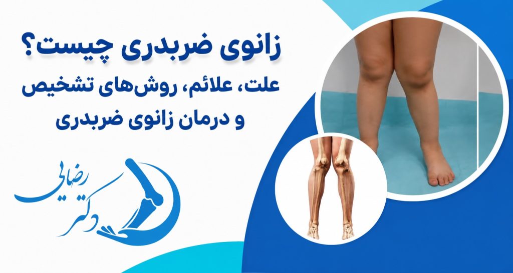 زانوی ضربدری چیست؟ علت، علائم، روش‌های تشخیص و درمان زانوی ضربدری