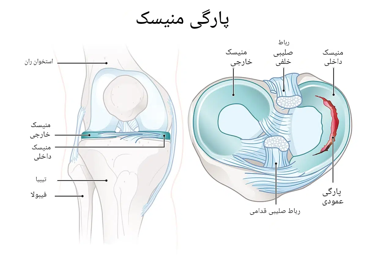 علت و درمان خالی کردن و ناپایداری زانو
