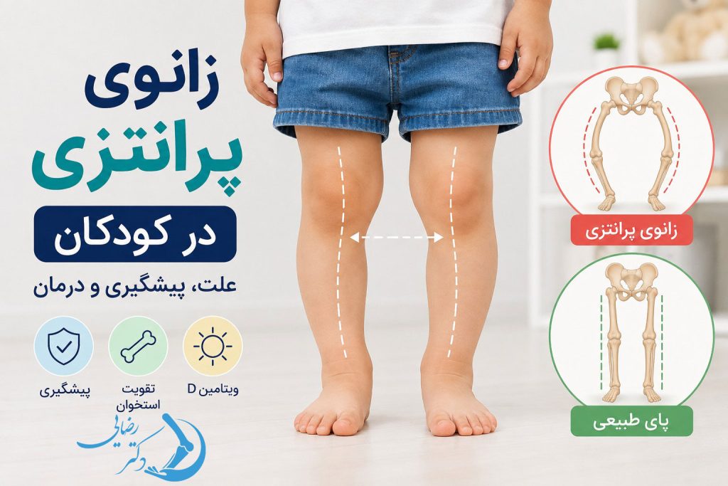 زانوی پرانتزی در کودکان؛ علت، پیشگیری و درمان