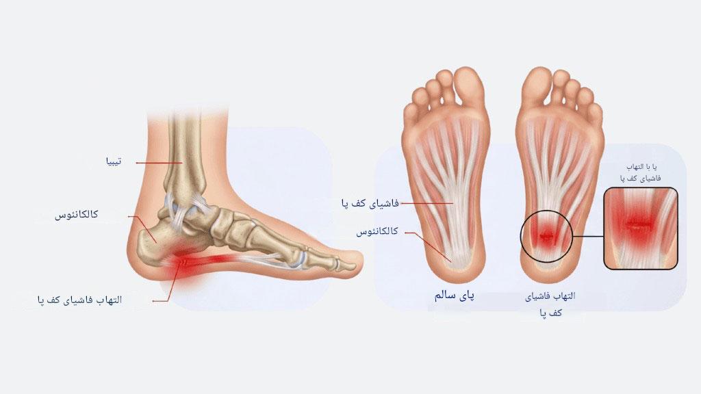 آسیب‌ها و مصدومیت‌های فوتبال؛ 10 آسیب رایج و روش‌های درمان