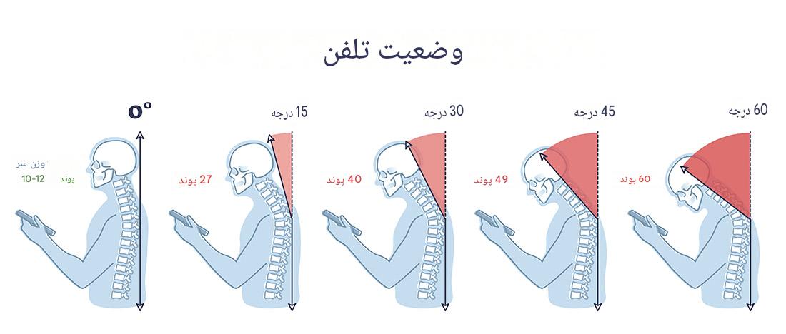 موبایل و قوز گردن؛ درمان گردن درد ناشی از استفاده نادرست از موبایل