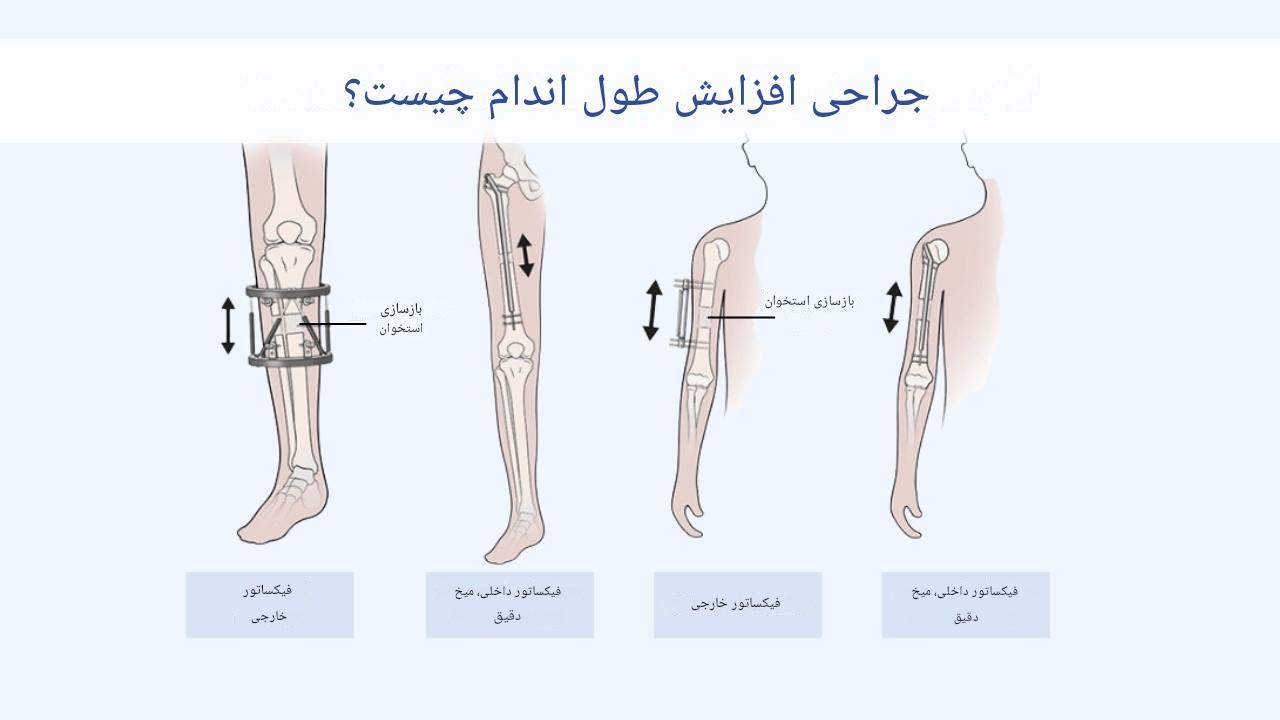 افزایش قد بعد از بسته شدن صفحات رشد؛ علائم، سن بسته شدن و راه‌های افزایش قد