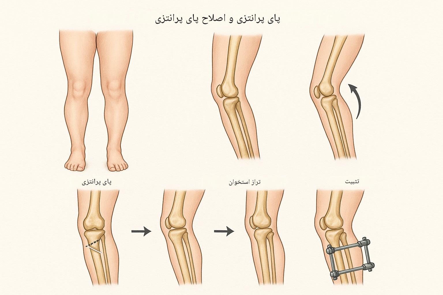 بیماریها و ناهنجاریهای مادرزادی ارتوپدی؛ از نقص استخوان تا بدشکلی مفاصل و ستون فقرات