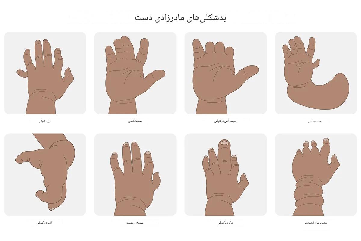 بیماریها و ناهنجاریهای مادرزادی ارتوپدی؛ از نقص استخوان تا بدشکلی مفاصل و ستون فقرات