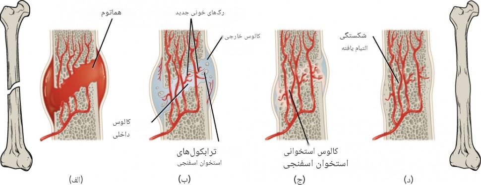 درمان انواع شکستگی استخوان در کودکان و بزرگسالان + از گچ‌گیری تا جراحی