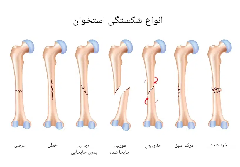 درمان انواع شکستگی استخوان در کودکان و بزرگسالان + از گچ‌گیری تا جراحی